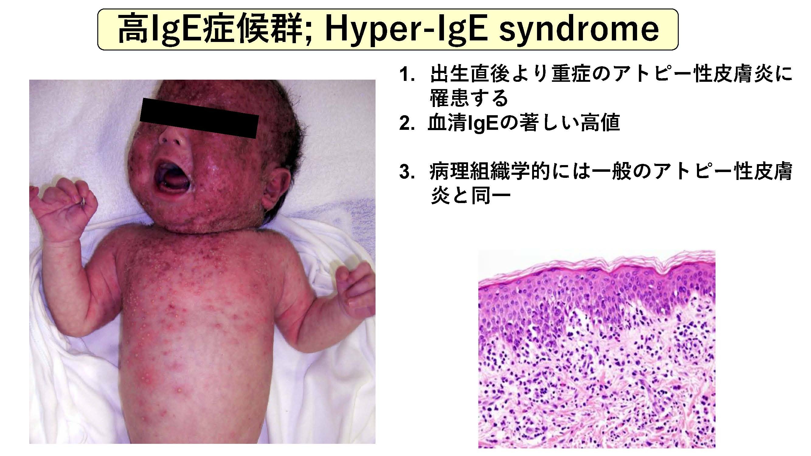 高IgE症候群；Hyper-IgE syndrome